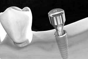 Dental Implants Turkey | High Quality & Low Cost With Attelia | Attelia Dental Turkey - Global Award Winning & Innovative Dental Clinic in Antalya