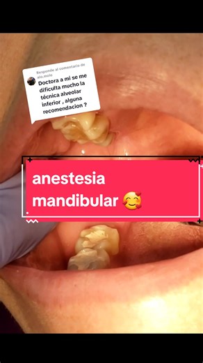 Técnicas de Anestesia Mandibular: Bloqueo y Tips Efectivos