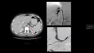 Adrenal Vein Sampling – The Most Technically Difficult "Routine Procedure" in Interventional Radiology