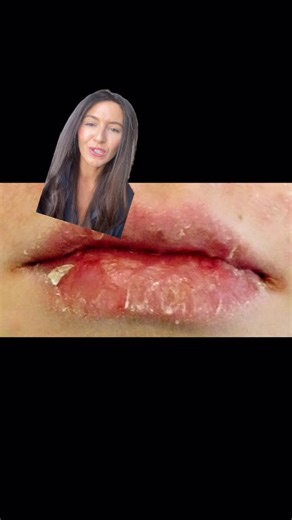 Jessica Burgy | Board Certified Dermatologist on Instagram: "Ditch the chapstick and instead using a gentle exfoliating acid once a week along with hyaluronic acid + petroleum based product for the softest lips 👄 Are your lips dry all of the time? What’s worked for you? #drylips #chappedlips #crackedlips #chapstick"