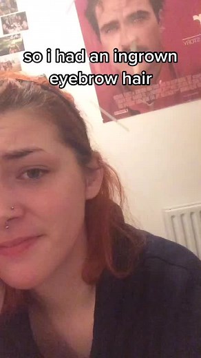 How to Remove Ingrown Eyebrow Hair Safely at Home