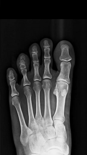 Fracture of distal phalanx of 4th toe noted with surrounding soft tissue edema. #xrayfoot