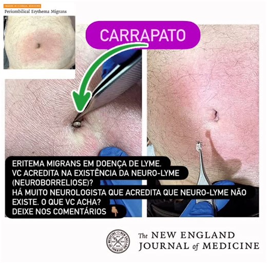 NeuroTube on Instagram: "🧠 Neuro-Lyme (Neuroborreliose) A neuro-Lyme é o comprometimento do sistema nervoso na Doença de Lyme, infecção causada pela Borrelia burgdorferi, transmitida por carrapatos. Pode surgir semanas a meses após a infecção inicial, especialmente quando não tratada precocemente. 🔹 Manifestações neurológicas mais comuns • Meningite linfocitária subaguda (cefaleia, fotofobia, rigidez discreta) • Paralisia facial periférica, muitas vezes bilateral • Radiculoneurite dolorosa (do