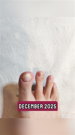 Witness the power of precision podiatry! 💅