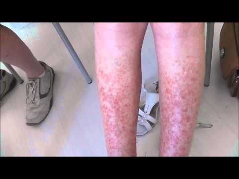 A very severe case of Sun Allergy (Polymorphic Light Eruption) before and 5 days after treatment