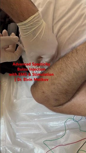 Advanced Spasticity Botox Injection with EMG & Stimulation | Dr. Elvin Malikov