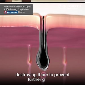 1K reactions · 15 shares | ‍ Tired of constantly shaving and waxing? Laser Hair Removal is the Solution!  朗 Our safe and effective treatment will give you Smooth & Silky Skin than ever before.﫶  5 Lacs + Satisfied Customers  100% Safe & Painless  Expert Doctors | Berkowits Hair & Skin Clinic | Facebook