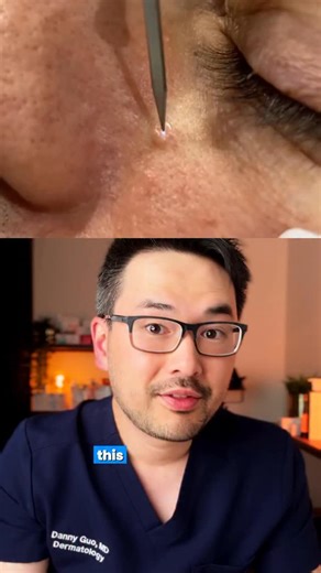 Dr. Danny Guo | Dermatologist on Instagram: "‼️HOW TO TREAT - SEBACEOUS HYPERPLASIA‼️ Sebaceous hyperplasia is made up of dilated oil glands in the skin and appears as a yellow bump. Treating them can be done in several ways but the most effective in my experience has been electrodessication, which is to use energy currents to zap them off. Don’t try at home treatments because they usually will not work but can cause scars and pigmentation instead. #dermatologist #sebaceoushyperplasia #skincare"