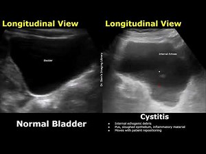 Bladder Ultrasound Normal Vs Cystitis Imaging Findings | Increased Wall Thickness, Internal Echoes