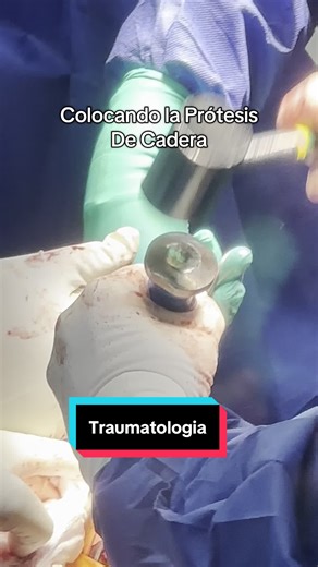 Colocando la Prótesis Definitiva en Cirugía de Cadera