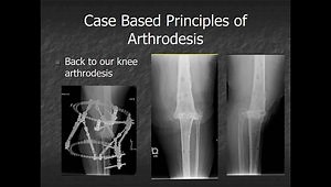 Knee Arthrodesis Revisited