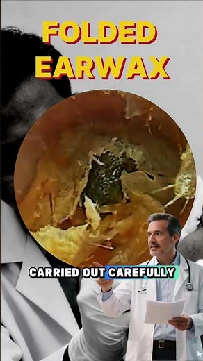 EPS 26| Professional Ear Cleaning for Severe Earwax Buildup #earwaxremoval #feedshorts #shorts