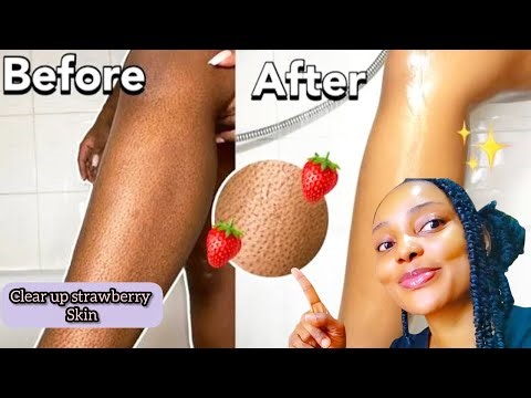 HOW TO GET RID OF STRAWBERRY LEGS + TRUSTED Products the cure ROUGH,TEXTURED, & BUMPY SKIN in 2025