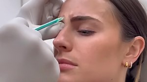 Woman compared face before and after Botox injections to show major difference