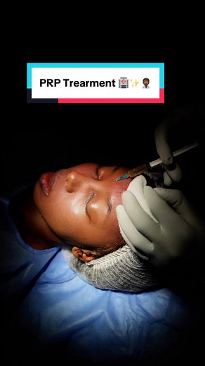 PRP Treatment for Glowing Skin & Hyperpigmentation