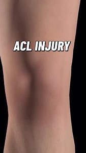 11K views · 158 reactions | ACL Injury The anterior cruciate...