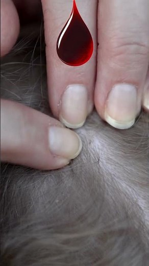 “Why Lice Spread So Fast? Explained in 35 Seconds!”