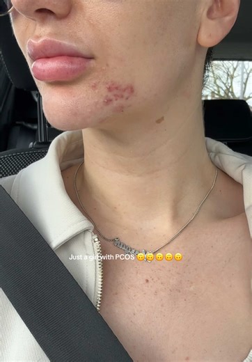 Dealing with Chin Acne and PCOS