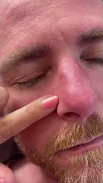 More dandruff removed from eyebrow