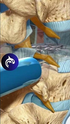 See how a TLIF relieves back pain and restores spinal stability with a 3D Animation.