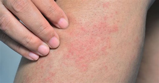 Assaduras no calor: saiba como evitar e cuidar do problema