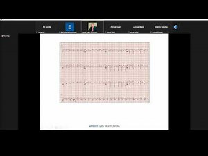 Atypical AVNRT Dr Ahmed Nabil