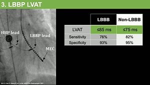 Comparative LVAT Between Stimulation Sites - His Bundle Pacing, Left Bundle Branch Pacing, Left Ventricular Septal Pacing