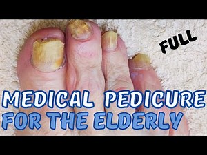 Satisfying medical pedicure for the elderly. Ram`s horn & fungus.