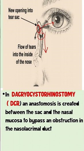 DCR - Dacrocystorhinostomy #ophthalmology
