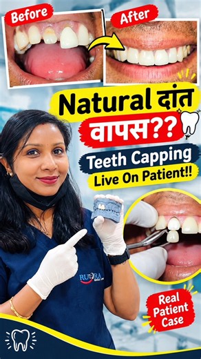 Natural दांत वापस?? 😱 Teeth Capping Before & After |Front Teeth Capping #trending #reels #patient