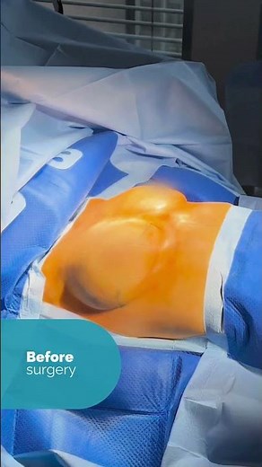 Live from the Operating Room: breast lift surgery