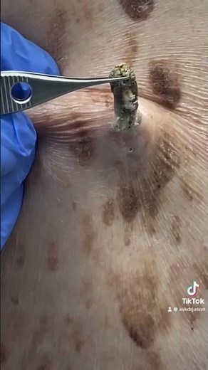 Dilated Pore of Winer Removal by a Dermatologist #dermatology