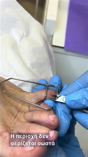 Μεσοδακτύλιος κάλος Ανακουφίστε άμεσα τον πόνο στη βάδιση | Advanced Foot Care