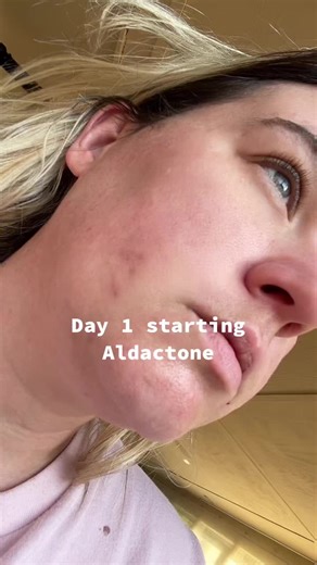 Just shy under 2 weeks of Aldactone. I was put on this for fluid retention BUT it had worked wonders on my skin! #fyp #skincare #hearthealth #aldactone #adultacne