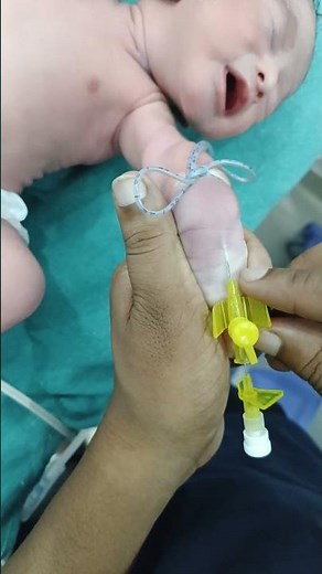 Inserting a Cannula in Newborns Made EASY!