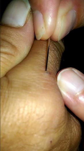 Splinter removal with puss