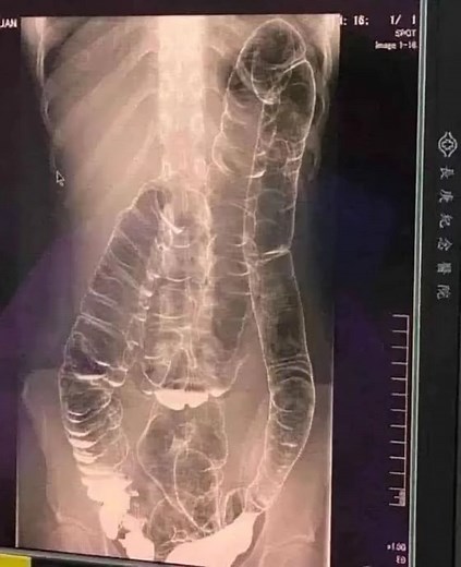 This is an X-ray image of a young woman who suffered from chronic constipation. One day, after experiencing continuous symptoms for over two weeks, she went for a medical check-up and received the X-ray results shown below...👇 | The Inspireist