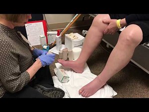 Lymphedema Compression Wrapping and Bandaging Therapy for Legs