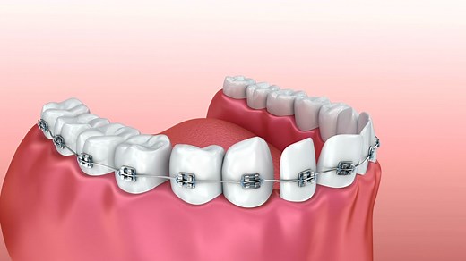 Teeth with braces Alignment process. Medically accurate 3D animation