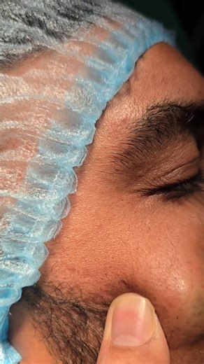 Face cyst extraction | Dr Khaled's Tumour Helpline