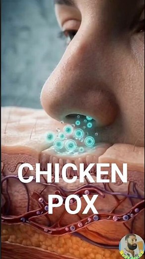 Chickenpox Explained