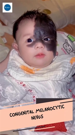 Dr Medica Clinical Cases || Congenital Melanocytic Nevus || Clinical Medicine ||