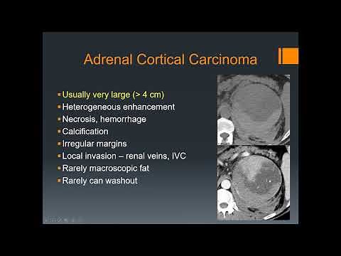 Imaging of adrenal gland