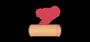 Coronary perforation emergency management - Type III