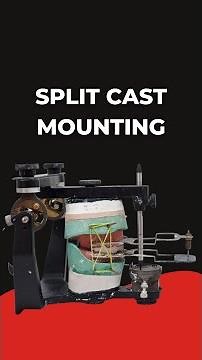 Split Cast Mounting in Complete Dentures