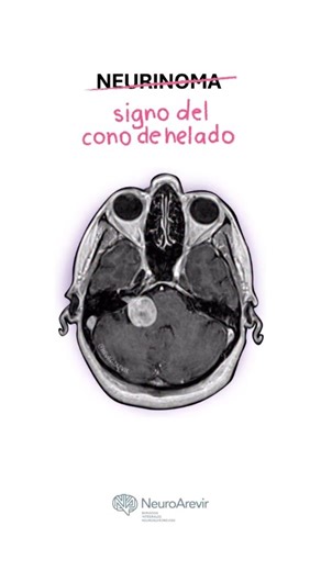 PAC FONOAUDIOLOGIA on Instagram: "Signo del "cono de helado" 🍦 🎬👉 @neuroarevir El signo del "cono de helado" 🍦 en un neurinoma (schwannoma vestibular) es un hallazgo radiológico clásico en la resonancia magnética que describe la forma del tumor: 🔅El cono: es la parte del tumor que se extiende dentro del conducto auditivo interno. 🔅 La bola: es la porción más grande que se expande en el ángulo pontocerebeloso, creando la forma de un helado en un cono. #logopedia #fonoaudiologia #speechlangu