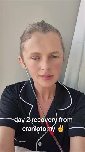 Day 2 of my recovery from craniotomy following previous burst aneurysm treated with coils in November 2023. feeling like ive been dug up but got this shiz! #recovery #craniotomy #aneurysm #brainsurgery #HRI