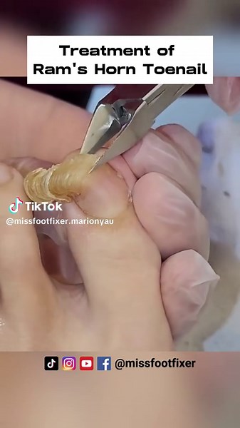 Ram's Horn Toenail: Causes, Treatment, and Prevention | Tips By Foot Specialist Miss foot fixer #toenailremovals #toenailfungus #toenailtreatment #missfootfixer