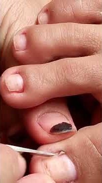 ingrown toenail and dryskin removal