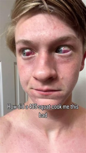 Ophthalmo_Mentor on Instagram: "Subconjunctival bleeding, also known as subconjunctival hemorrhage or subconjunctival haemorrhage, is bleeding from a small blood vessel over the whites of the eye. It results in a red spot in the white of the eye. There is generally little to no pain and vision is not affected. Generally only one eye is affected. Cr • @briefcaseofprs I think I popped a blood vessel #fyp #powerlifting #weightlifting #squat #gym #gymvideos #hashtag #weak #strong #gymrats #gymreels 